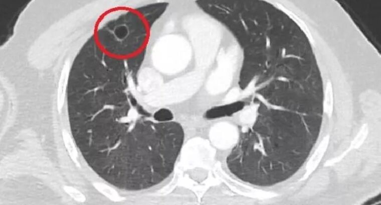 Первый случай в мировой литературе