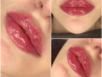 Увеличение губ . Russian lips