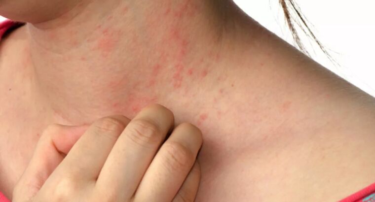 Случаи заболевания чесоткой в Турции продолжают увеличиваться