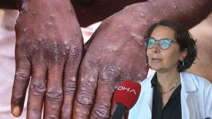 Что слышно о вирусе оспы обезьян?