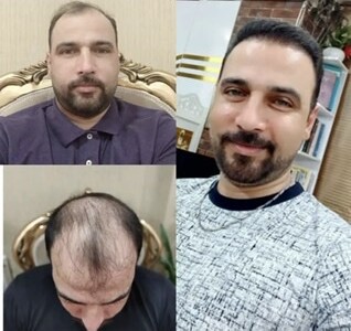 Пересадка волос в Стамбуле
