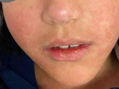 На этот раз предупреждение от специалистов о кори