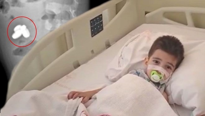 Ошибочный диагноз стоил здоровья: ребёнок проглотил батарейку и магниты