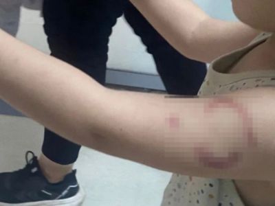 В Эдирне арестована воспитательница, укусившая трёхлетнего ребёнка в детском саду