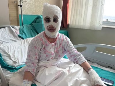 Во время подготовки к ифтару в Турции взорвалась скороварка: молодая женщина получила серьёзные ожоги
